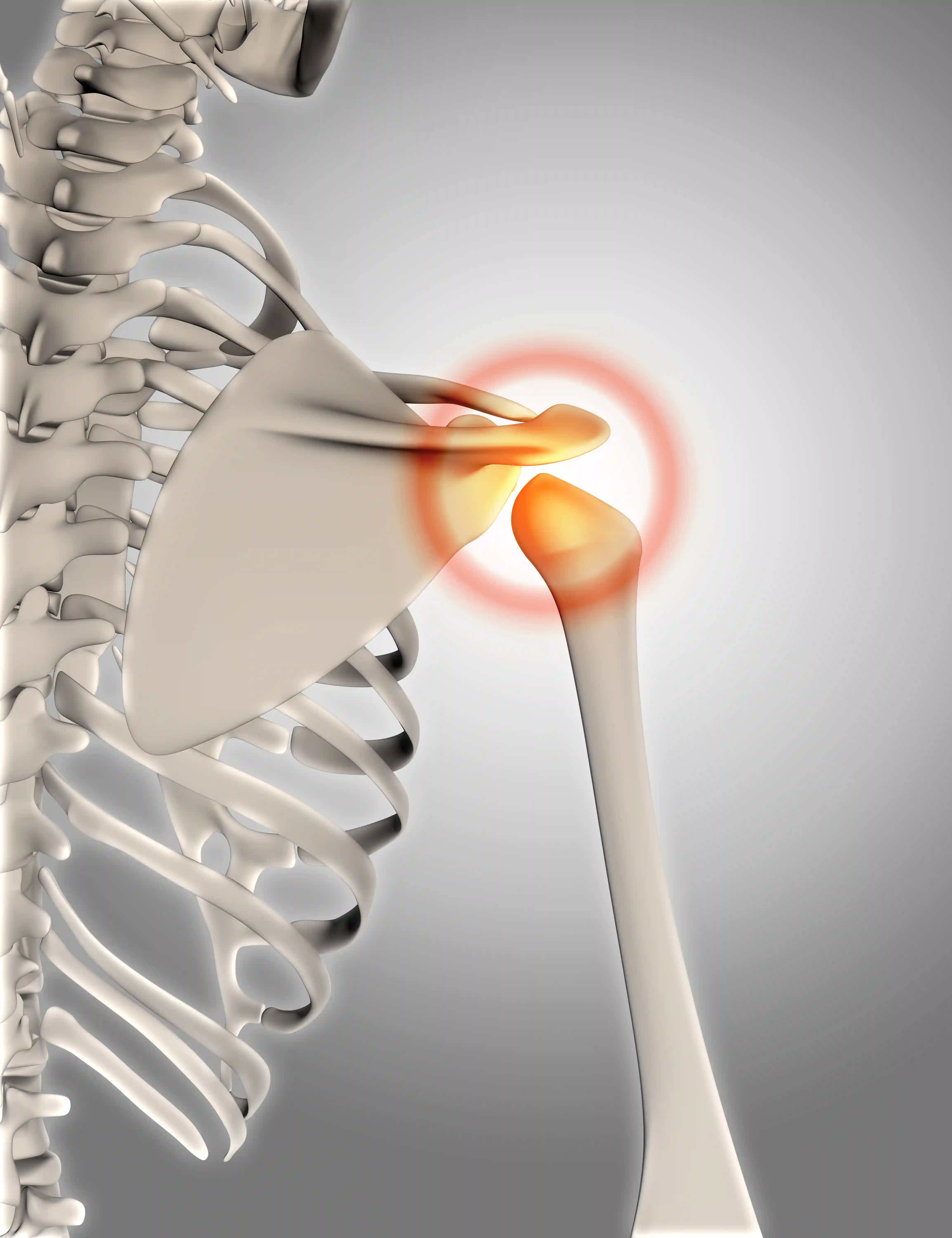 Rotator Cuff Repair